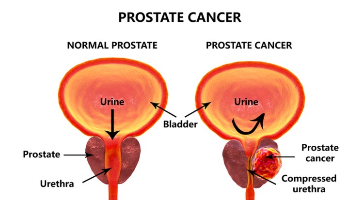 breast-cancer-facts-what-is-breast-cancer