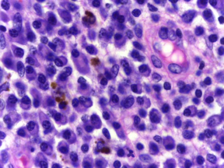  breast-cancer-facts-what-is-breast-cancer