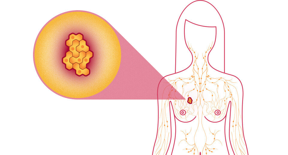 breast-cancer-facts-what-is-breast-cancer