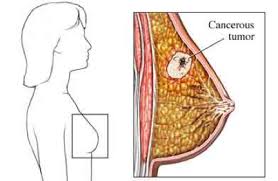 Breast Cancer Stages